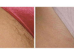 DEPILAZIONE UOMO/DONNA A BRESCIA PREZZI LOW-COST