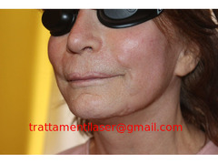 Trattamenti laser