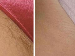 DEPILAZIONE UOMO E DONNA A BRESCIA