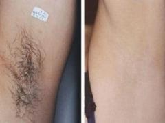 DEPILAZIONE UOMO E DONNA A BRESCIA
